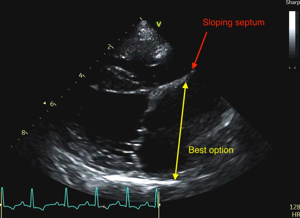 Dilated LA and bowed septum
